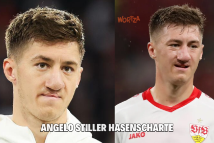 Angelo Stiller Hasenscharte